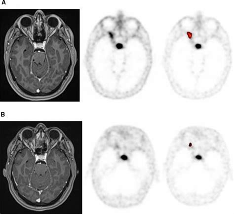 Optic nerve sheath meningioma. A Pre-RT imaging: T1 post-contrast MRI,... | Download Scientific ...