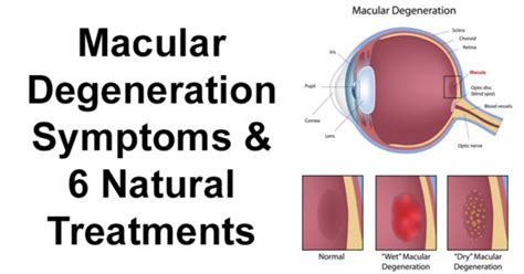 Macular Degeneration Symptoms & 6 Natural Treatments - David Avocado Wolfe