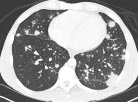 Cavitary lung nodules as an extraintestinal manifestation of ulcerative colitis | BMJ Case Reports