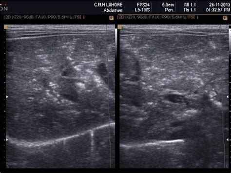 Liver Portal Vein Ultrasound