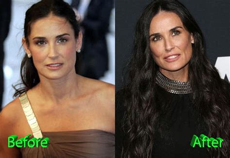 Demi Moore Surgery Transformation Before and After - Plastic Surgery ...