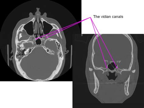 Skull and Spine: The Vidian Canal