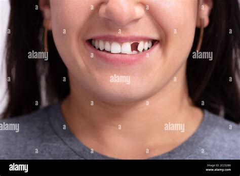 Missing teeth woman hi-res stock photography and images - Alamy