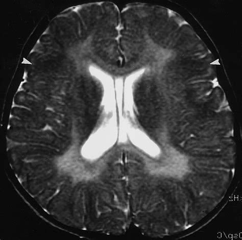 Metachromatic Leukodystrophy