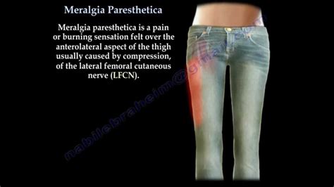 Meralgia Paresthetica - Everything You Need To Know - Dr. Nabil Ebraheim - YouTube