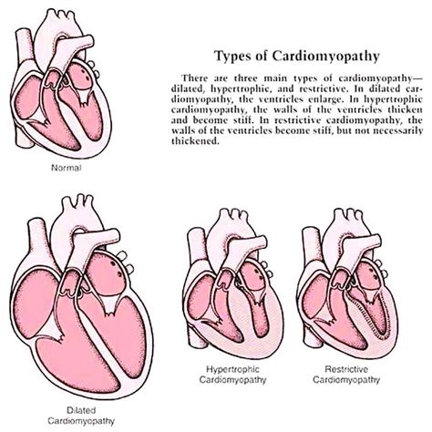 Hypertrophic Cardiomyopathy Types