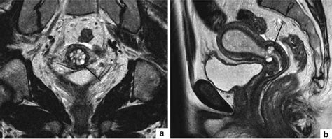 Uterine Cervix | Radiology Key