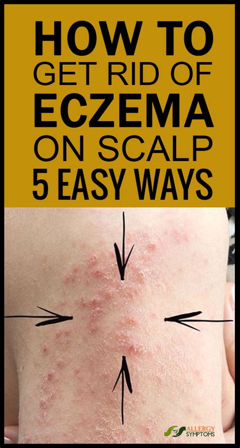 How to Get Rid of Eczema on the Scalp? - Allergy Symptoms