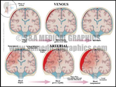 Neurosurgical Complications - S&A Medical Graphics