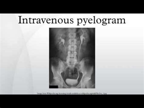 Intravenous pyelogram - YouTube