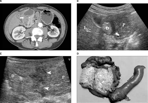 Sonographic Findings in Groove Pancreatitis - Wronski - 2011 - Journal of Ultrasound in Medicine ...