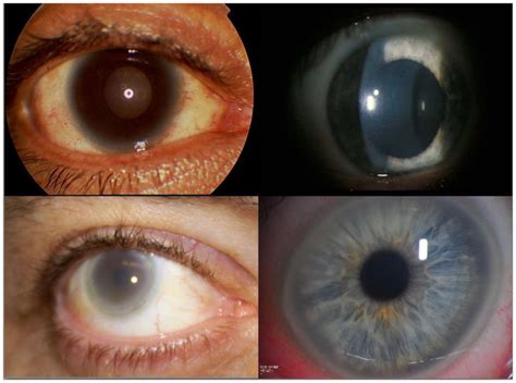 Images of corneal arcus and corneal opacification are shown. In the ...