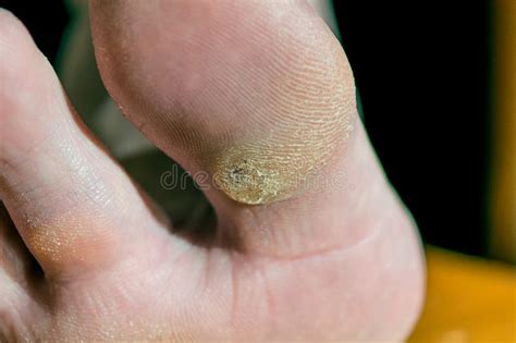 Plantar Wart on Big Toe. Visible Black Dots Warts Stock Image - Image of foot, people: 94631969