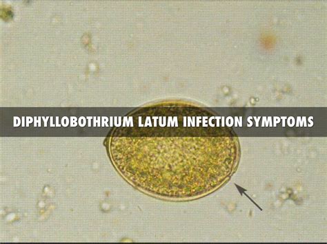 diphyllobothrium latum infection by akeylar