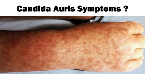 Effective Skin Care Tips for Candida Auris Symptoms . - Fit Foresight