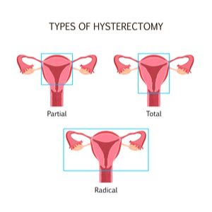 How Much Does Hysterectomy Cost? (2022)