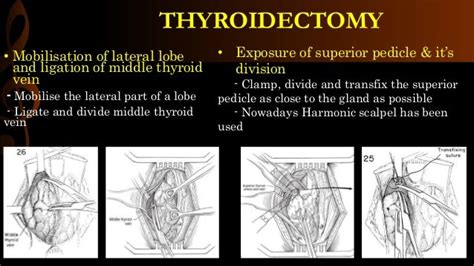 Thyroidectomy- operative surgery