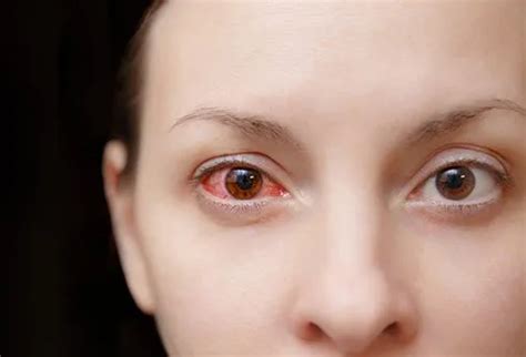 Scleritis Treatment, Symptoms, Causes & Risk Factors - Okkii.com