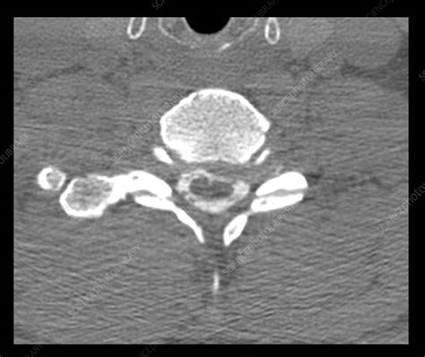 Cervical Myelogram CT - Stock Image - C027/1646 - Science Photo Library