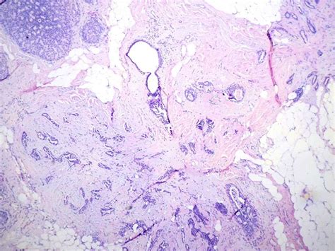 Pilar cyst (head) – BosnianPathology