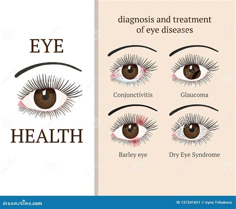 Most common eye problems. stock vector. Illustration of conjunctiva ...