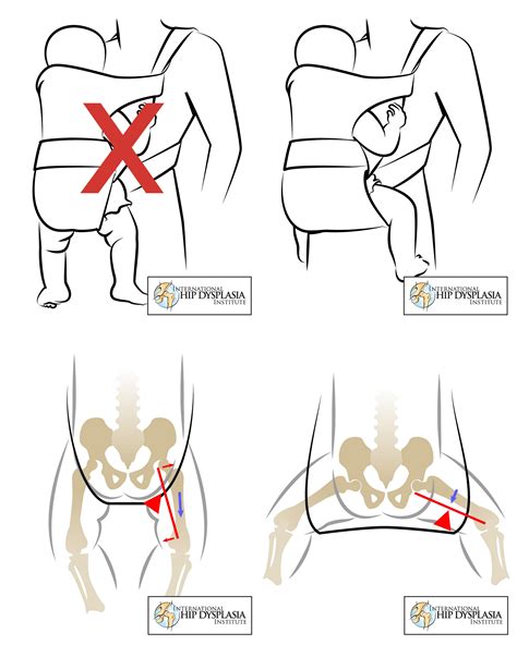 Baby Carrier Leg Support to Prevent Hip Dysplasia (www.hipdysplasia.org/Developmental-D… | Baby ...