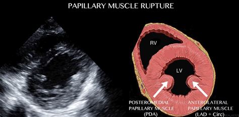 Papillary Muscle Blood Supply