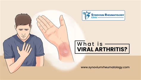 What is Viral Arthritis? | Synovium Rheumatology Clinic