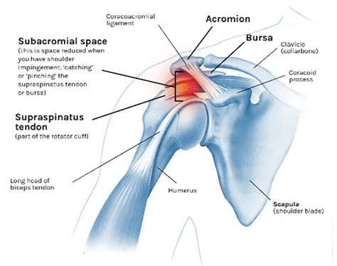 Shoulder Impingement Syndrome - Your Physio