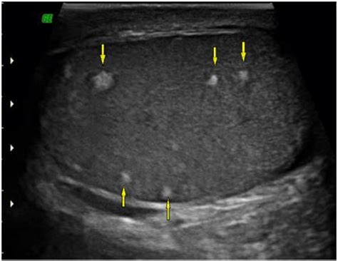 Ultrasound sagittal view demonstrate multiple ill-defined hyperechoic... | Download Scientific ...