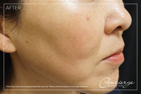 B and A - Laser IPL (Facial Age/Brown Spots) | Concierge Aesthetics