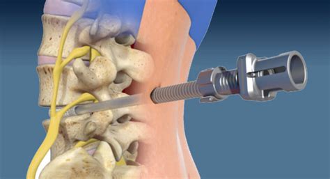 Minimally Invasive Procedure to Alleviate Low Back and Leg Pain - Mega Doctor News