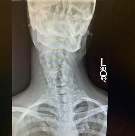 Neck Scoliosis with an extra side of bone mass : r/XRayPorn