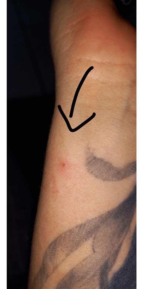 does this look like a tick bite ? : r/Lyme