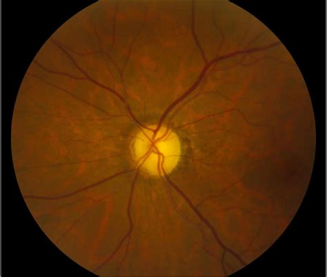 Optic nerve atrophy causes, symptoms, diagnosis & treatment