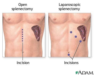 Spleen removal - series—Incision: MedlinePlus Medical Encyclopedia