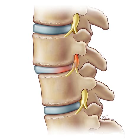 Spondylolisthesis | Weill Cornell Brain and Spine Center