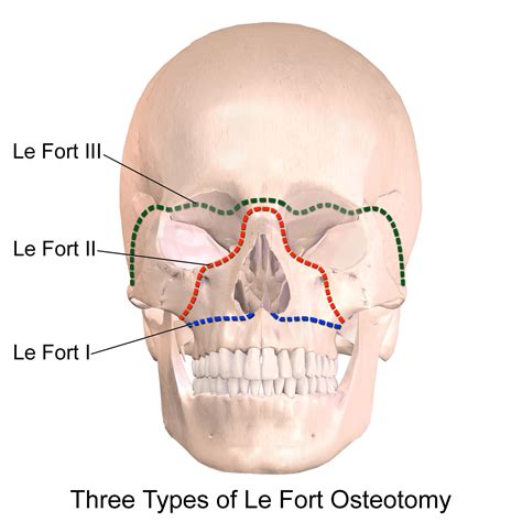 emDOCs.net – Emergency Medicine EducationLe Fort Fractures - emDOCs.net ...