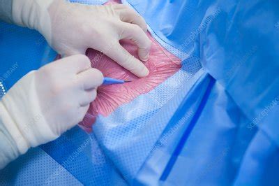 Implantable defibrillator surgery - Stock Image - C037/6176 - Science Photo Library