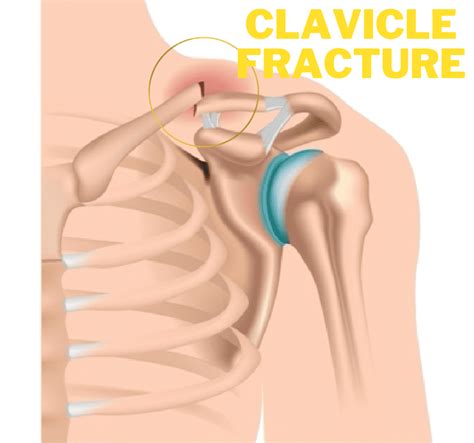 Clavicle Fracture: Symptoms, Causes and Recovery/Rehabilitation ...