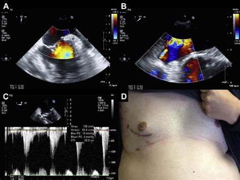 Postoperative transesophageal echocardiogram showing (A) left... | Download Scientific Diagram