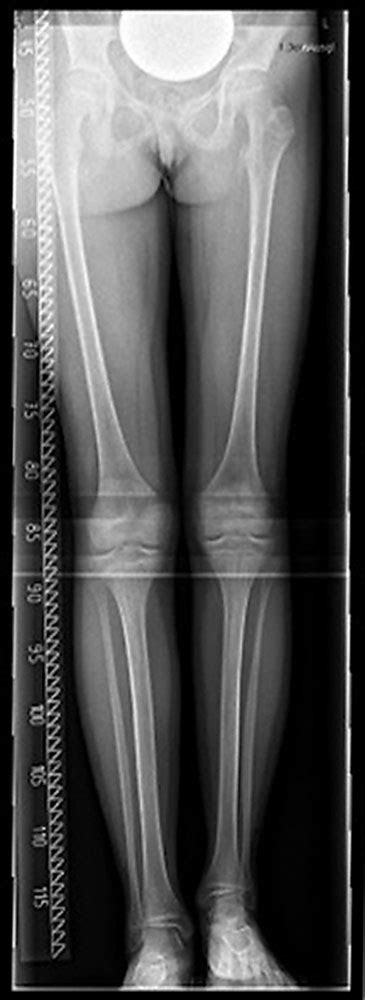 Compva: Limb length discrepancy