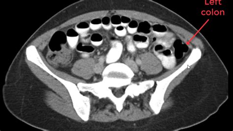 Abdomen and Pelvis CT Search Pattern in 5 minutes - YouTube