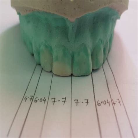 (PDF) Smile designing using recurring esthetic dental proportion and ...