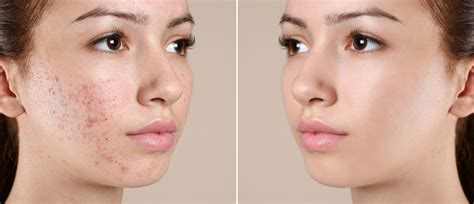 How Long Does an Acne Facial Last for Clearer Skin? - Hagerstown