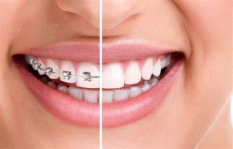 Invisalign vs Braces: Which Is Better For You? - The Stylus