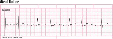 Type 1 Atrial Flutter