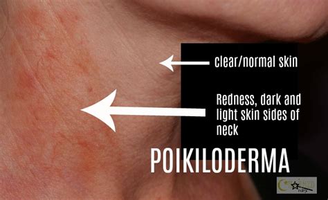 Do You Have This Common Neck Discoloration Called Poikiloderma ...