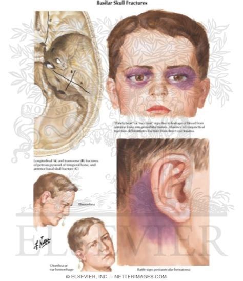 Basilar Skull Fracture Diagram