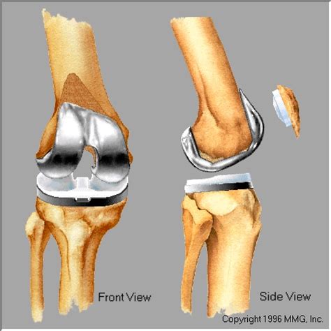 Knee Degenerative Joint Disease | Orthopaedic Center Of Southern Illinois